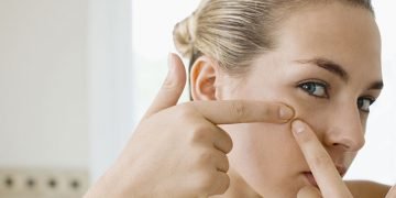 7 Tips Better Ways to Remove Acne on Your Face